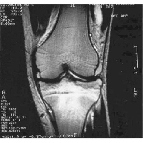 Left Knee Magnetic Resonance Imaging Mri Showed Signal Changes In