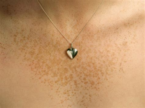 chest freckles led one woman to discover she had a rare form of breast cancer national