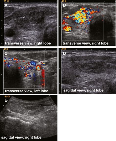 In addition, following treatment for thyroid cancer ultrasound provides a safe tool for disease surveillance. A Case of simultaneous occurrence of Marine - Lenhart ...