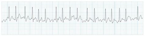 Cardiac Tamponade Ecg Strip