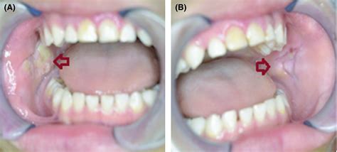 On‐site Treatment Of Oral Ulcers Caused By Cheek Biting A Minimally