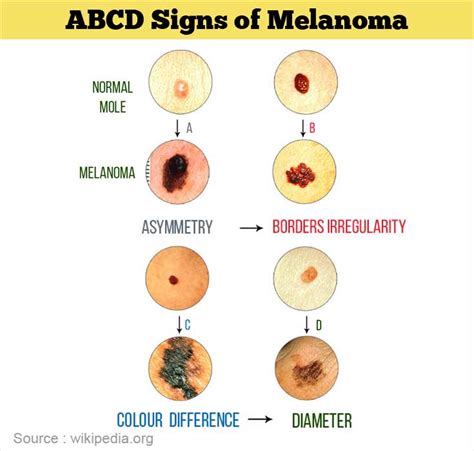 Malignant Melanoma Symptoms Doctor Heck
