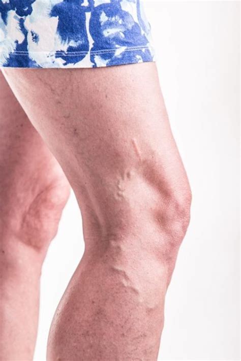 Your Varicose Veins May Be More Than Just A Cosmetic Concern Tinsley