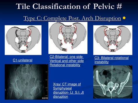 Pdf Classification Of Pelvic Fractures And Its Clinical Relevance My XXX Hot Girl