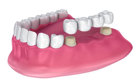 How Do Dental Bridges Work