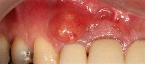 What Is A Jaw Cyst Operation Dent Avrasya Dental Clinic In Turkey