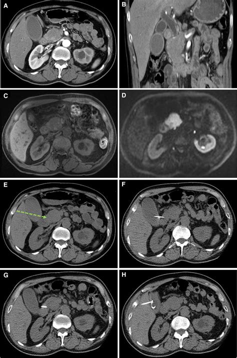 A Focal Mass Lesion Is Noted At The Pancreatic Head With Obstructive