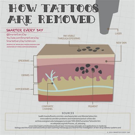 How Laser Tattoo Removal Works Infographic Indy Skin Renew