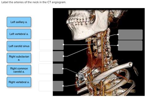 Branch of in the thoracic section, the left common carotid travels upwards through the superior mediastinum to the level of the left sternoclavicular joint where it. Solved: Label The Arteries Of The Neck In The CT Angiogram... | Chegg.com