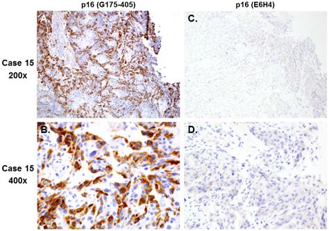 Case 15 P16 Negative Partial Staining With G175 405 But Not E6h4 A