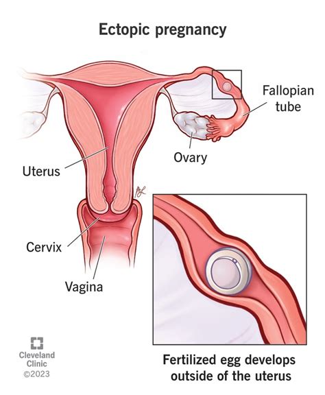 Understanding Ectopic Pregnancy Causes Symptoms And Treatment Ask The Nurse Expert