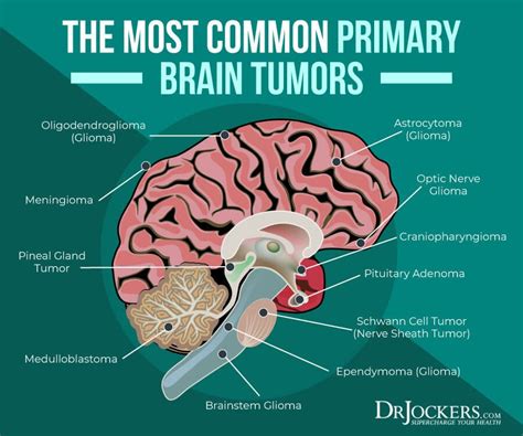 Pin On Brain Tumor
