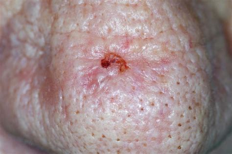 Basal Cell Skin Cancer On The Nose Photograph By Dr P