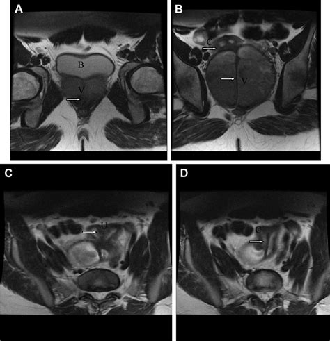 Rare Müllerian Anomaly Complete Septate Uterus With Simultaneous