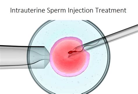 A Brief On Intrauterine Sperm Injection Treatment In Delhi