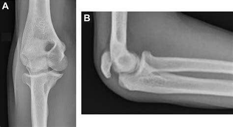 Surgical Treatment Of Displaced Olecranon Fracture Through A Persistent