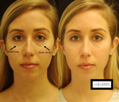 Tear Trough Under Eye Filler Before And After All You Need Infos