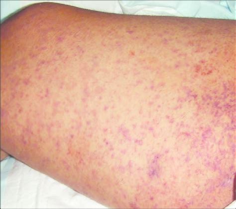 Maculopapular Rash With Central Petechiae Associated With Rocky