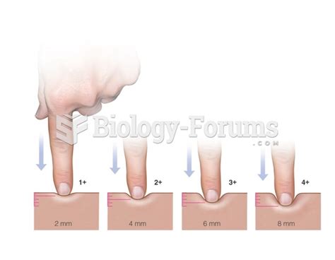 Pitting Edema Grading Scale Biology Forums Gallery