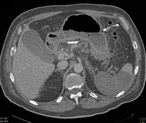 78306 nuclear bone scan whole body. Post Whipple Procedure with Large Splenic Infarct ...
