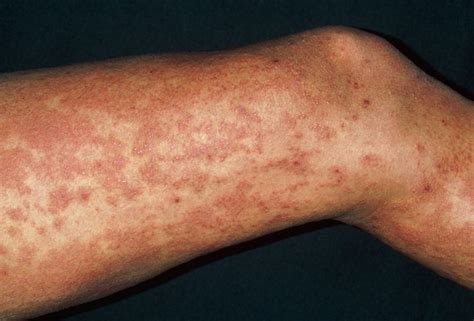 Wie Man 9 Häufige Hautausschläge Identifiziert