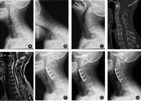 Frontiers Anterior Cervical Discectomy And Fusion To Treat Cervical