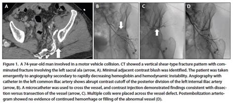 Endovascular Today Transcatheter Embolization For Trauma Of The