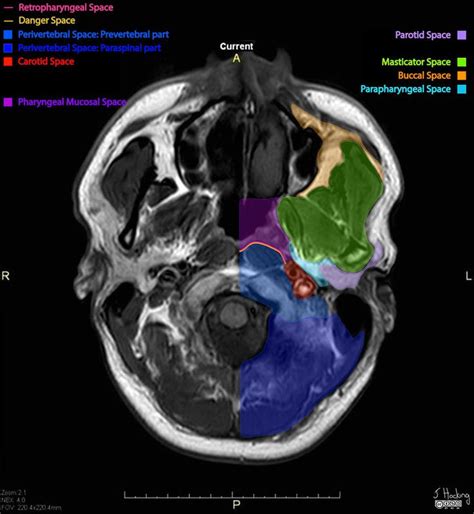 Deep Spaces Of The Head And Neck Annotated Mri Radiology Case