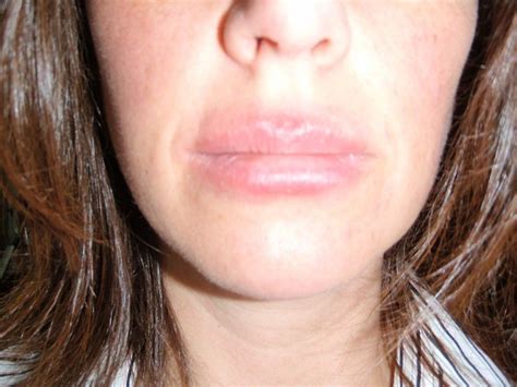 Acute allergic contact dermatitis caused by (a) topical herbal medicine for a sprained ankle (severe reaction), (b) fragrance in deodorant, and (c) adhesive tape used after abdominal hysterectomy. Common Causes of Recurrent Lip Rashes in 2020 | Allergic ...