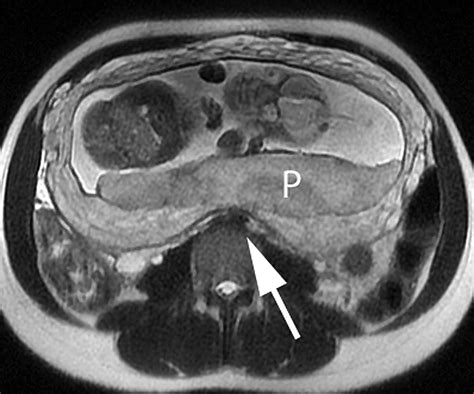 Placental Evaluation With Magnetic Resonance Radiologic Clinics