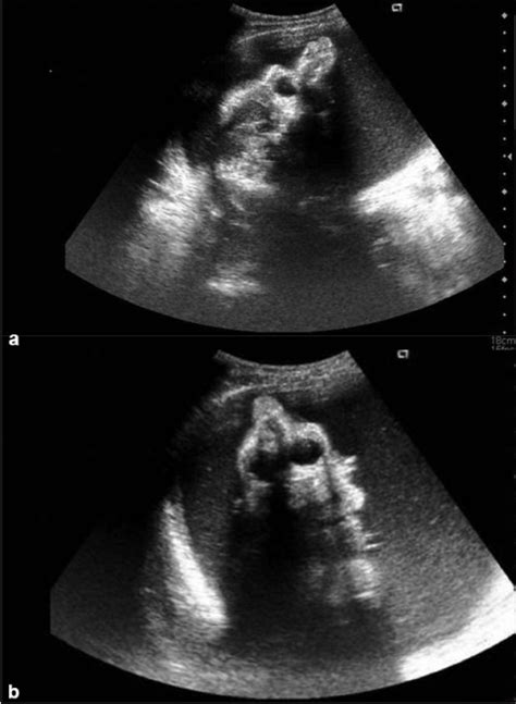 A Sagittal Ultrasound Scan Performed In The Antenatal Open I