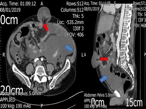 Axial And Sagittal Views Of The Ct Scan Prior To The Initial Emergency