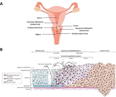 Anatomical Location Of Cervical Cancer Origin And Progression From A
