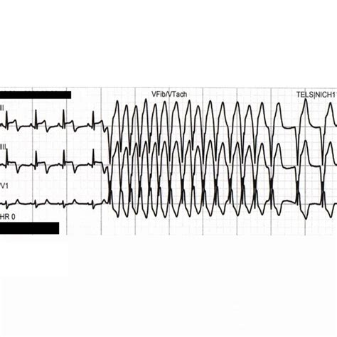 Case Of Coronary Vasospasm Caused By Hypocalcaemia Post