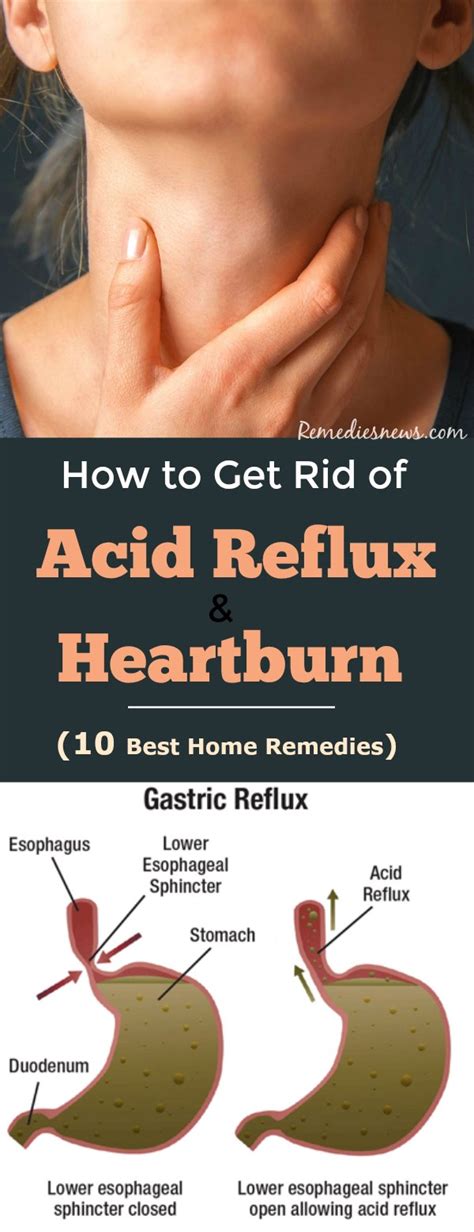 How To Get Rid Of Acid Reflux And Heartburn 10 Best Remedies