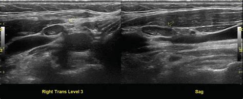 Normal Cervical Lymph Node Appearance And Anatomic Landmarks In Neck