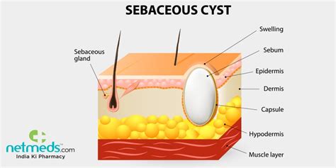 Sebaceous Cyst Causes Symptoms And Treatment