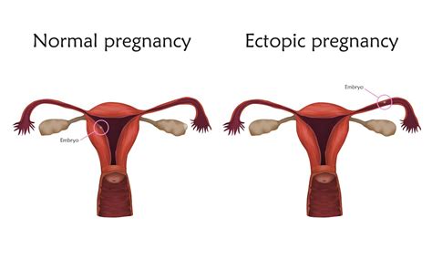 What Is Ectopic Pregnancy A Reproductive Health Expert Explains