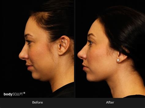 Kybella Before And After Photos Double Chin Treatment