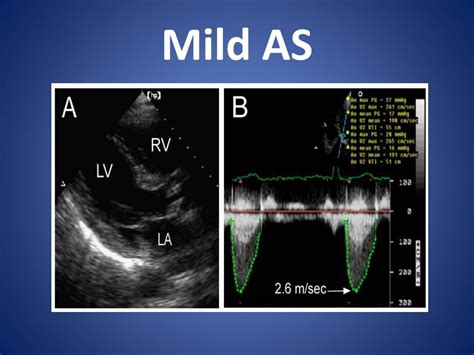 Ppt Echo Features Of Aortic Stenosis Powerpoint Presentation Free