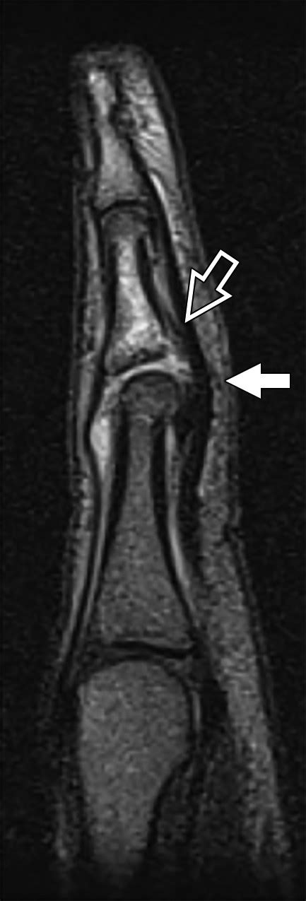 MRI Of The Fingers An Update AJR