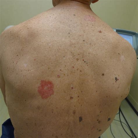 Skin Cancer Pictures