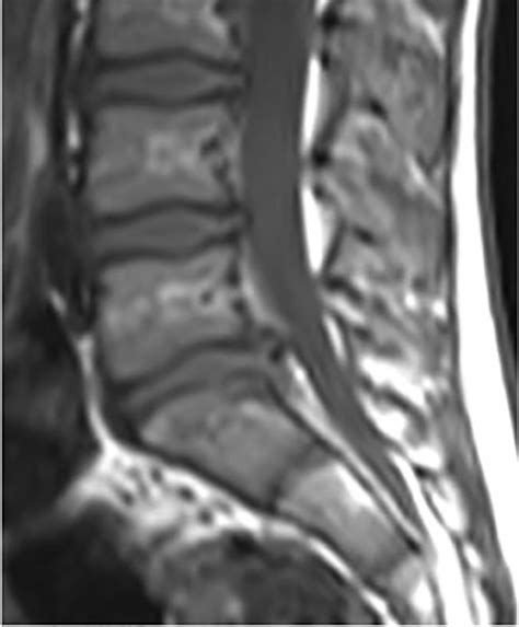 Posterior apophyseal ring fracture | Image | Radiopaedia.org