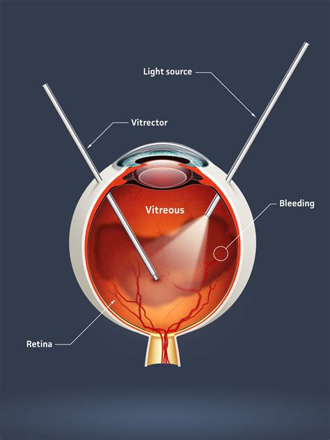 Vitrectomy For Floaters La Jolla Ca Eye Care Vision Correction