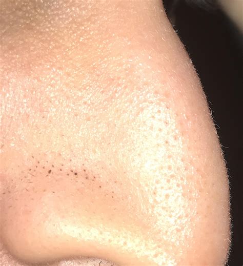 Skin Concerns These Black Spots On My Nose Never Go Away Please Tell