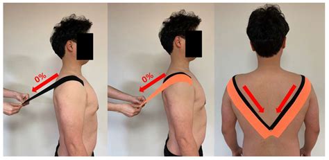 Life Free Full Text Effects Of Kinesiology Taping On Shoulder