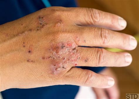 Ant Bites Pictures Treatment And Home Remedies Symptoms