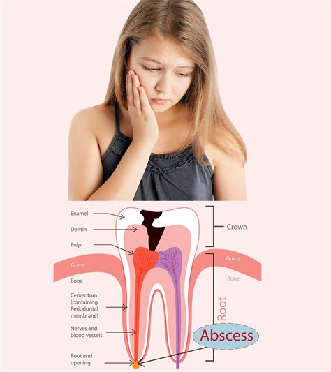 Cost Of Abscess Drainage Dental Jimmy Newpox