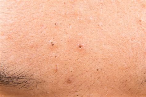 Closeup On Pimples Acne Zit Blackheads On Forehead Of Teenager Stock