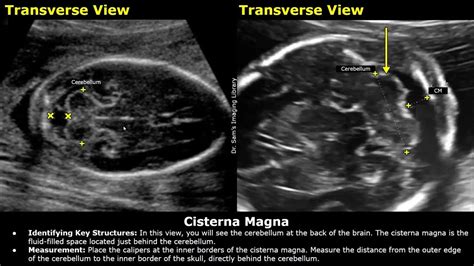 How To Measure Fetal Cisterna Magna On Ultrasound Fetal Brain Anomaly